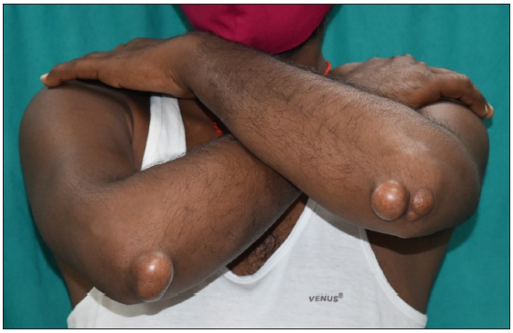 Homozygous familial hypercholesterolemia with xanthomas and a recurrent mutation
